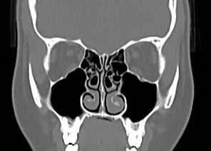 Problemy anatomiczne, które utrudniają prawidłowe oddychanie nosem